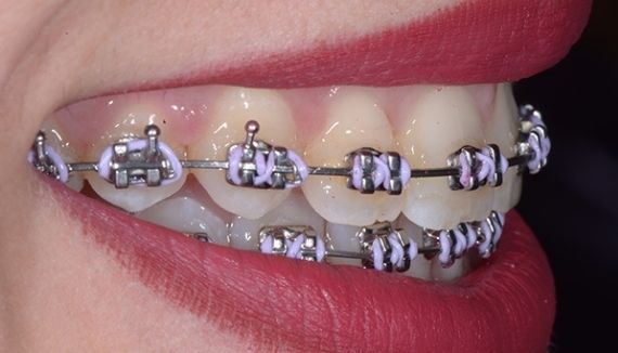 Quanti tipi di apparecchio per i denti esistono?